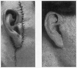 Scar: Improvements in Plastic Surgery, Before and After, c. 1920s