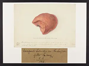 Lungs: Incipient Tubercles on the Lung