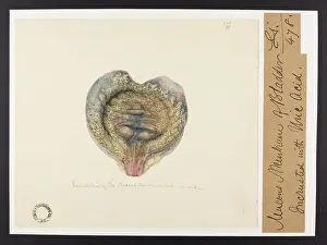 Membrane: Incrustation of the Mucous Membrane of the Bladder
