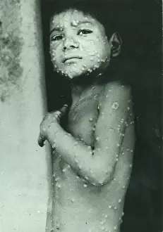 Smallpox: Last indigenous case of Smallpox in India, Katihar