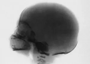 X Ray: Infant skull x-ray