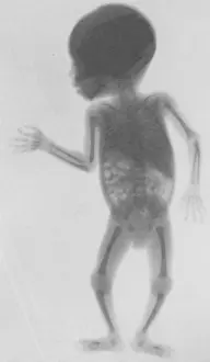 Procedure: Infant X-Ray, 1900