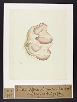 Inflamed: Inflamed Intestines covered in by Coaguable Lymph