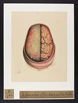 1826: Inflammation of the dura and pia mater