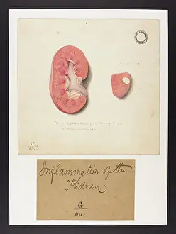 Kidney: Inflammation of the Kidney