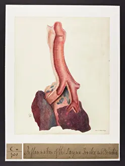 Larynx: Inflammation of Larynx, Trachea and Bronchia