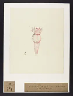 1826: Inflammation of Medulla Oblongata and Spinal Cord