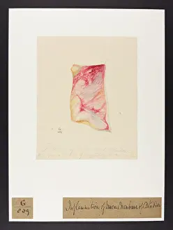 1826: Inflammation of Mucous Membrane of Bladder
