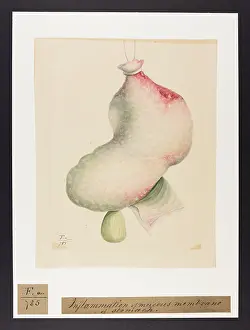 Stomach: Inflammation of the Mucous Membrane of Stomach