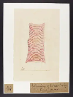 Blank: Inflammation of Mucous Membranes of Jejunum