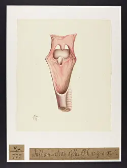 Pharynx: Inflammation of Pharynx