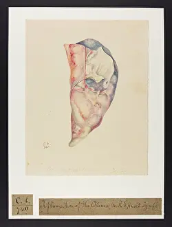 Pleura: Inflammation of the Pleura