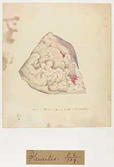 Pleura: Inflammation of the Pleura