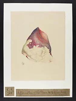 Pleura: Inflammation of the Pleura