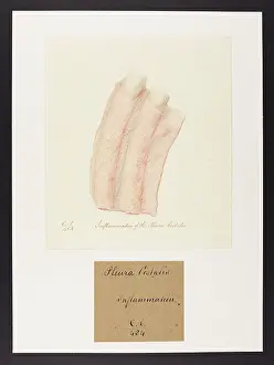 Septr: Inflammation of the Pleura Costalis