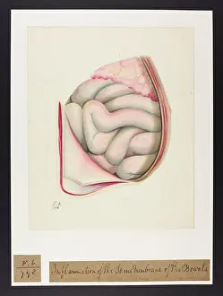 Blank: Inflammation of Serous Membrane of Bowels