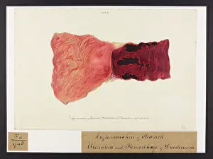 1834: Inflammation of Stomach: Ulceration, Haemorrhage of Duodenum