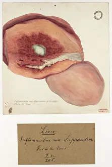 Liver: Inflammation and Suppuration of the Liver