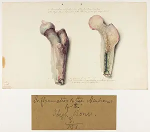Separation: Inflammation and Suppuration of the Medullary Membrane