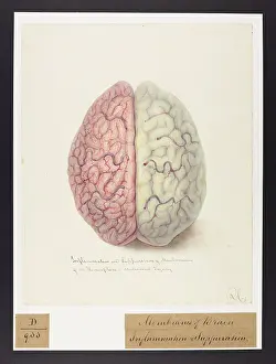 Hemisphere: Inflammation & Suppuration of Membranes of One Hemisphere