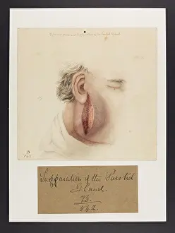 1831: Inflammation and Suppuration of the Parotid Gland