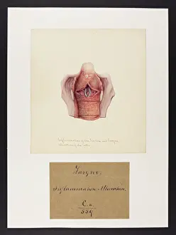 1831: Inflammation of the Trachea and Larynx