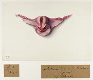 1837: Inflammation and Ulceration of OS Uteri