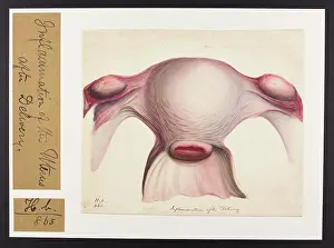 Uterus: Inflammation of Uterus after Delivery
