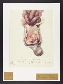 Peritonitis: Inguinal Hernia, Peritonitis