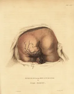 Ulcers: Inoperable aneurysmal tumor on the buttocks, 1815