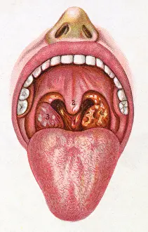 Throat: Inside of a mouth of person with diphtheria