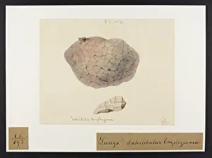Blank: Interlobular Emphysema