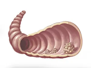 Digestive: Intestinal Polyps, Illustration