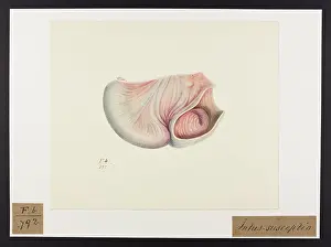 Ileum: An Intussusception with Jejunum/Ileum