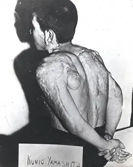 Plutonium: Japanese Nuclear Bomb Victim