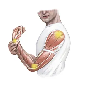 Elbow: Joint Pain, Illustration