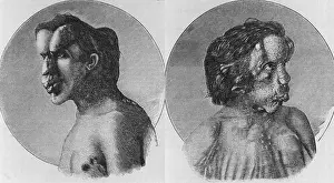 Merrick: Joseph Merrick (1862-1890), known as the ?