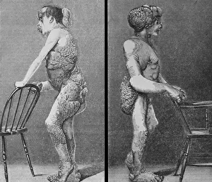 Merrick: Joseph Merrick (1862-1890), known as the ?