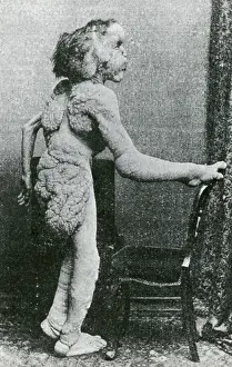 Deformed: Joseph Merrick, The Elephant Man