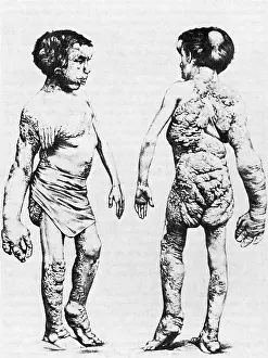 Deformed: Joseph Merrick, The Elephant Man