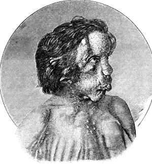 Deformed: Joseph Merrick, The Elephant Man