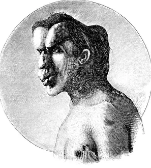 Deformed: Joseph Merrick, The Elephant Man