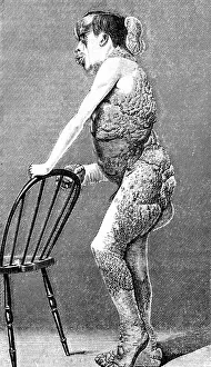 Deformed: Joseph Merrick, The Elephant Man