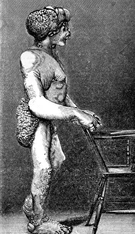 Deformed: Joseph Merrick, The Elephant Man