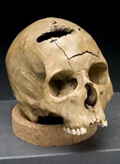 Forensic: Keyhole Gunshot Trauma, 1860's