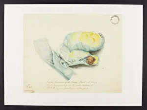 1826: Kidney: Adipose Conversion. Renal calculus. Abscess