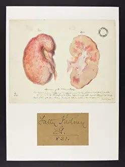 Ucl Library Services Digital Collections: Kidney in Dropsy