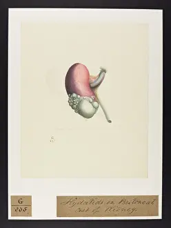 Hydatids: Kidney: Hydatids Adhering to the Peritoneal Surface