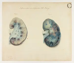 Suppuration: Kidney: Inflammation and Suppuration