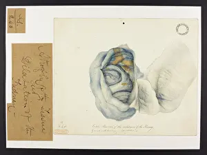 Removal: Kidney: Removal of the Substance. Dilatation of the Ureter